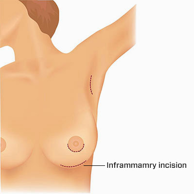 What Is Inframammary Breast Augmentation?