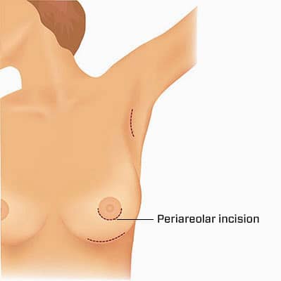 periaerolar incision | breast augmentation | John Q. Cook, M.D.