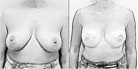 sketch Breast Reconstruction Before After