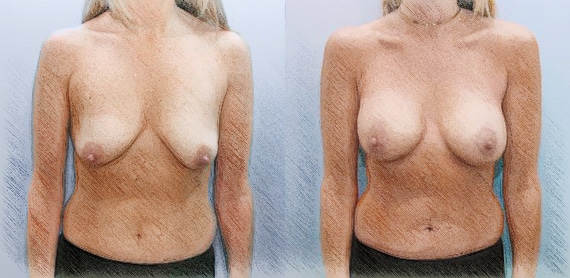 Breast Lift and Augmentation | Dr. John Q. Cook | Chicago and Winnetka