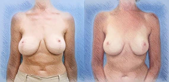 Revision of Breast Lift | John Q. Cook, M.D. | Whole Beauty Institute