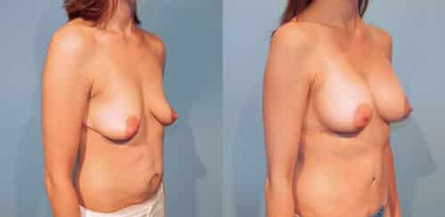 Structural breast augmentation combined with abdominoplasty.