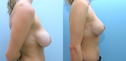 Structural Mastopexy: A Great Leap Forward for Breast Lift Surgery
