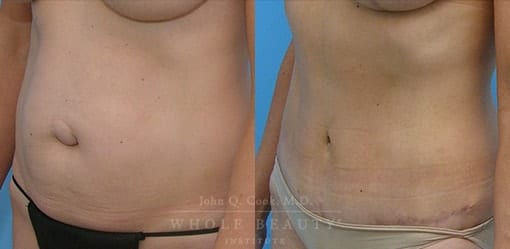 abdominoplasty-case-02-2