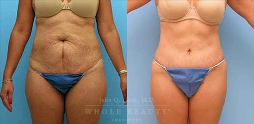 Tummy Tuck before and after by John Q. Cook, M.D.