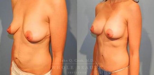 abdominoplasty-case-06-side