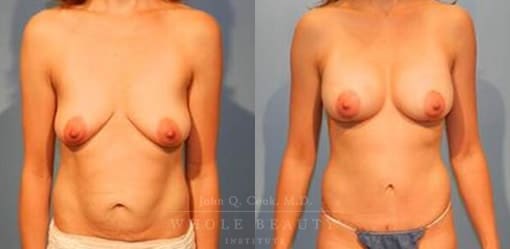 abdominoplasty-case-15