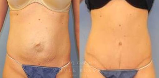 abdominoplasty-case-16
