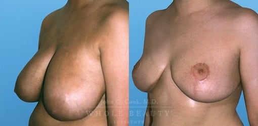 breast-reduction-case-01-fixed
