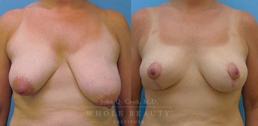 breast-reduction-case-02-fixed