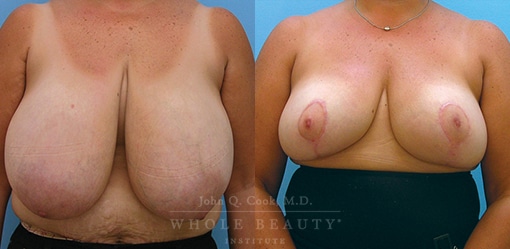 breast-reduction-case-03-fixed