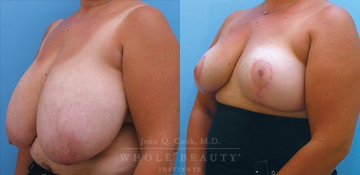 breast-reduction-case-03-side-fixed