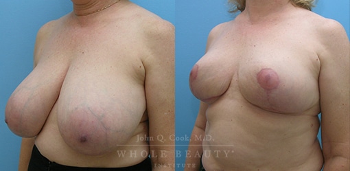 breast-reduction-case-05-fixed