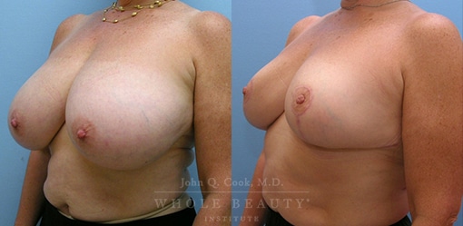 breast-reduction-case-06-fixed