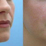 Facial Fat Transfer Before and After