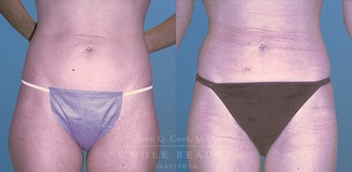 liposuction-case-1-01