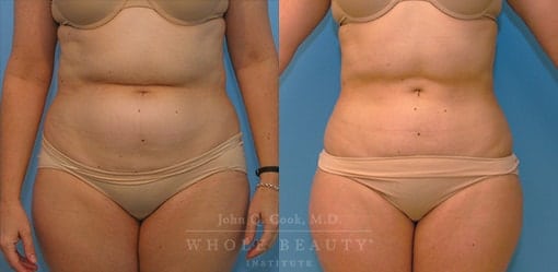 liposuction-case-2-01