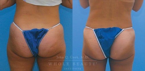 liposuction-case-4-03
