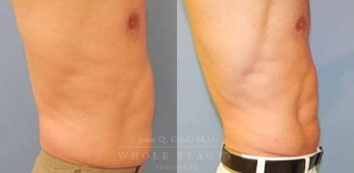 liposuction-case-5-03
