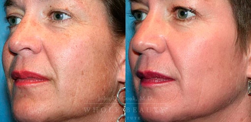 melasma-treatment-case-2-01