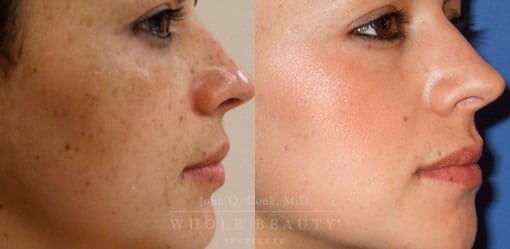 melasma-treatment-case-3-01