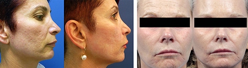 original_fractora_04_med