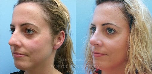rhinoplasty-case-1-angled