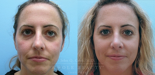 rhinoplasty-case-1-front