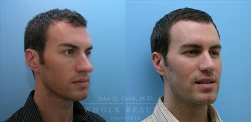 rhinoplasty-case-2-angled
