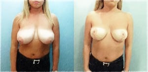 Structural Breast Reduction. Click here to view in photo gallery.