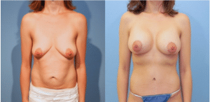 Breast Augmenation with Structural Mastopexy