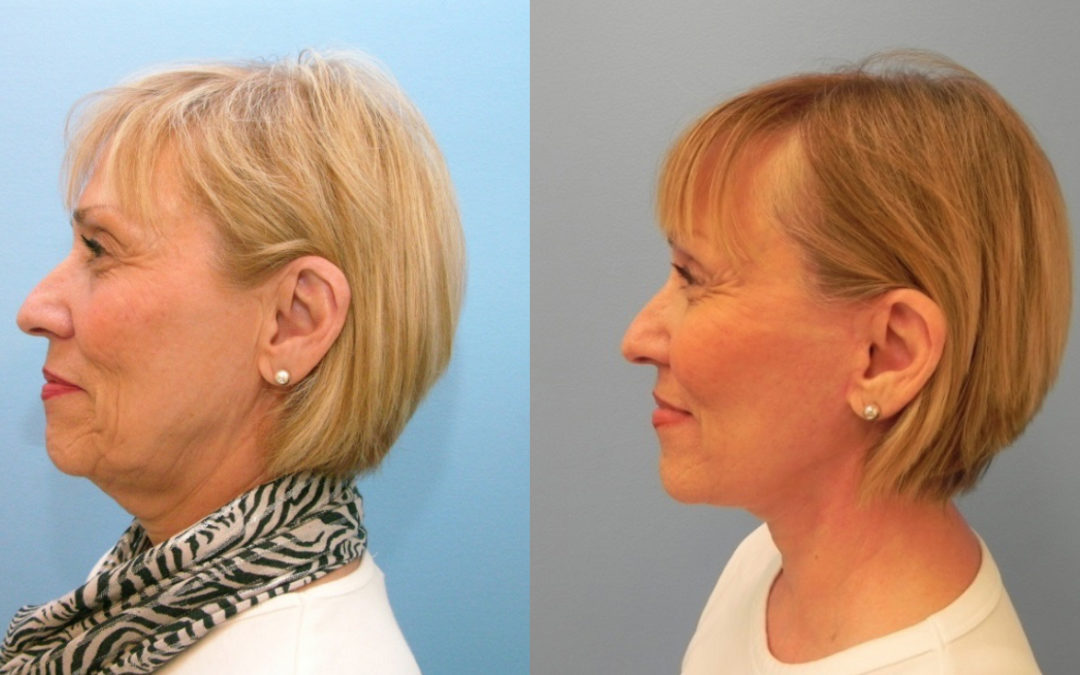 neck jaw border lift before after