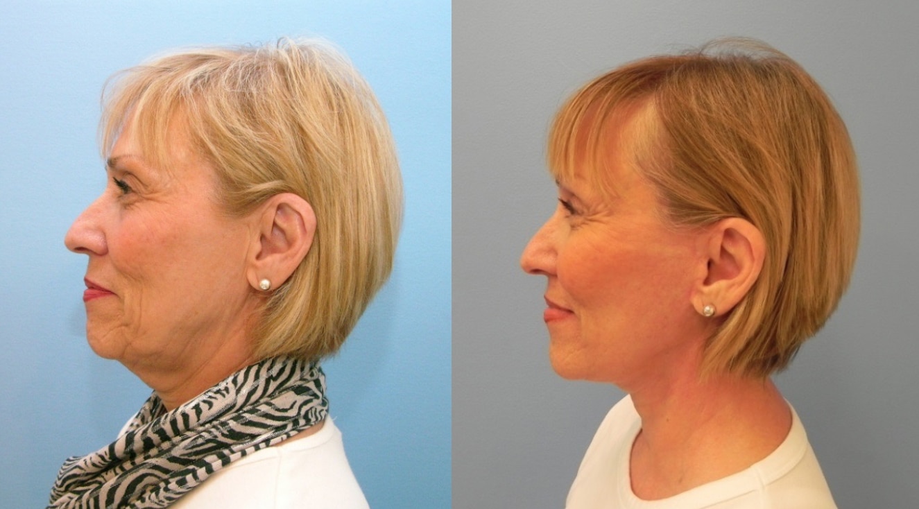 Neck Jaw Border Lift – before and after