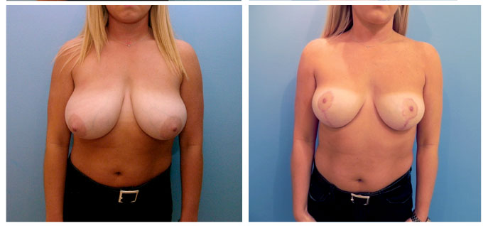 Structural Breast Reduction, side view, before and after