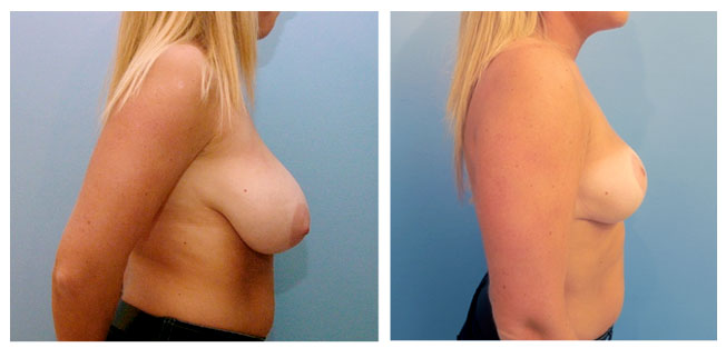 Structural Breast Reduction, front view