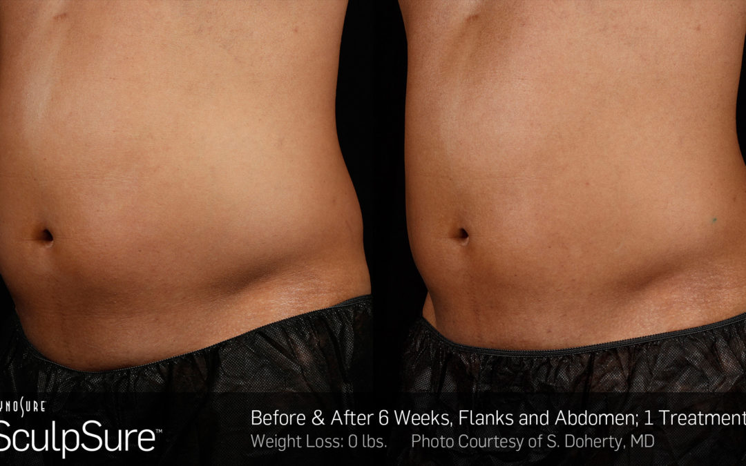 Sculpsure – Non-Surgical Fat Reduction