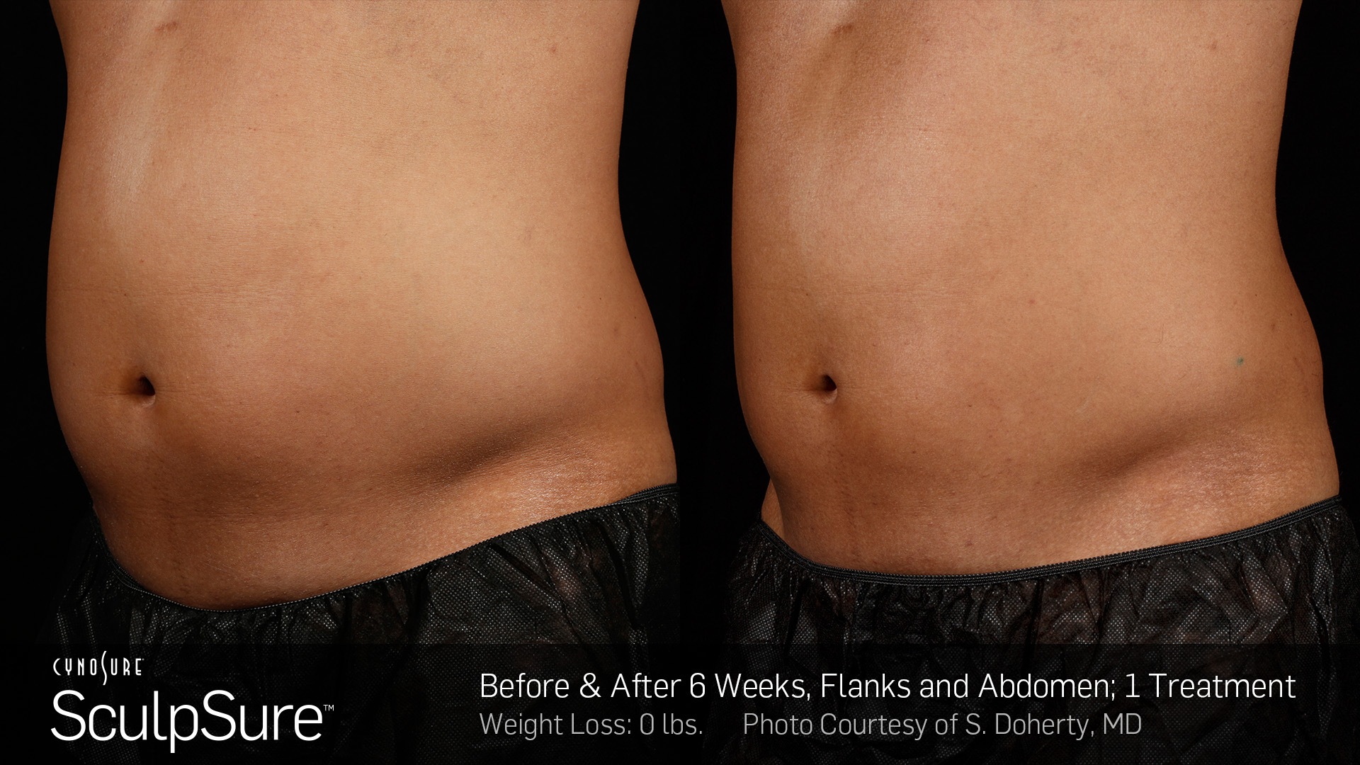 SculpSure treatment before and after.