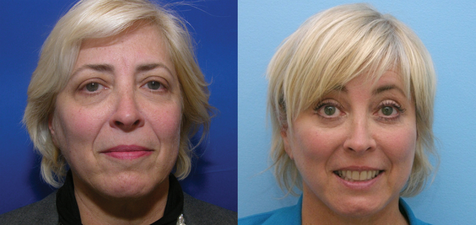 face lift - before and after