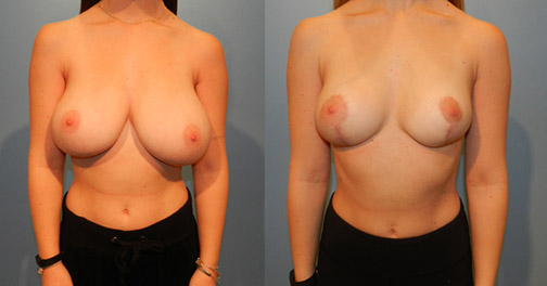 Structural breast reduction before and after