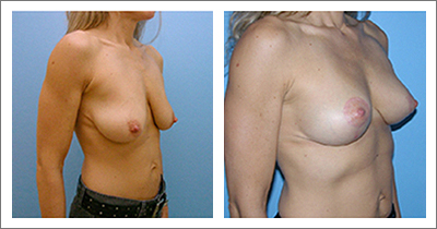 Structural Breast Lift without Implants