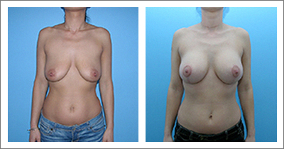 Structural Breast Lift and Volume Enhancement with Implants 