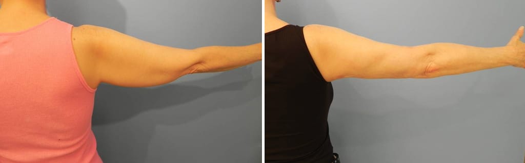 Arms_Before_and_After