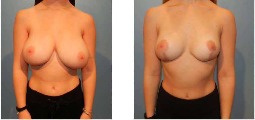 Structural breast reduction before and after.