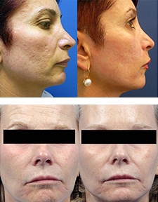 Examples of Forma treatments before and after.