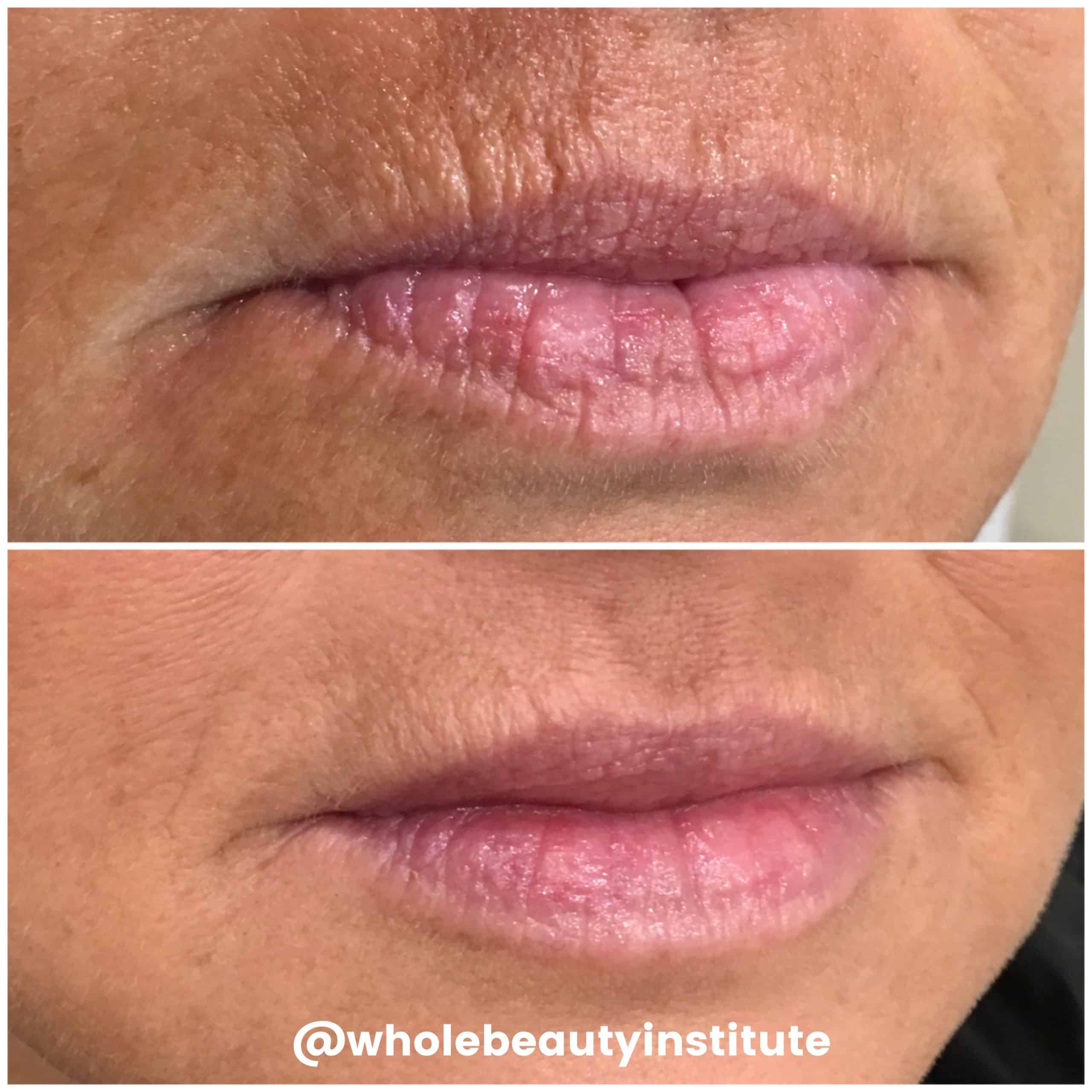 Volbella patient before and after