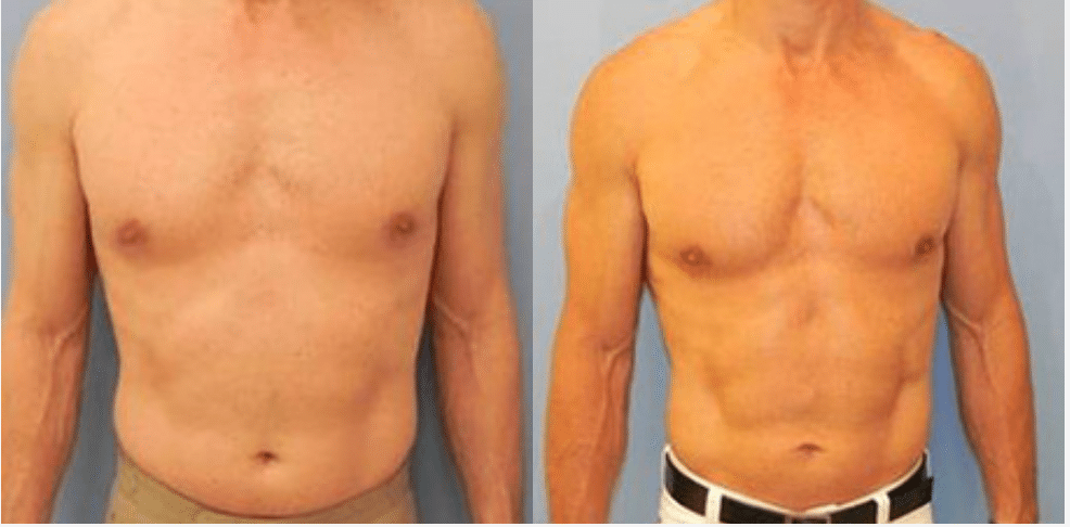 SlimLipo® laser liposuction before and after