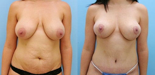 Structural breast lift