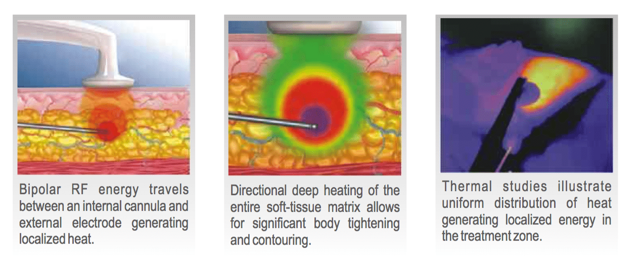 FaceTite® Treatment Steps