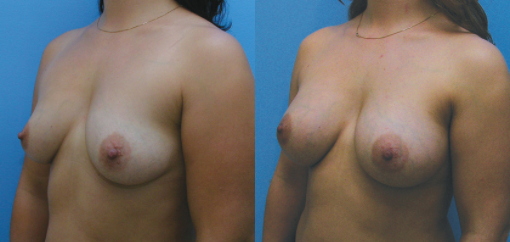 Breast Augmentation with Pectoral Repositioning