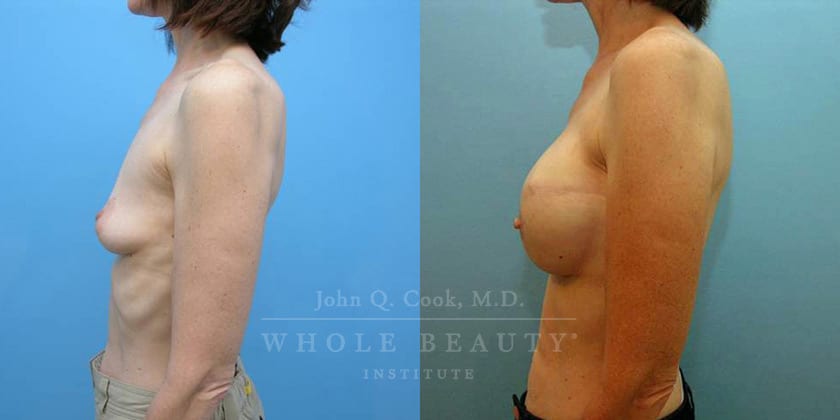 breast-reconstruction-case-12